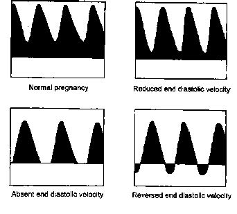 Umbilical Artery Doppler Graph