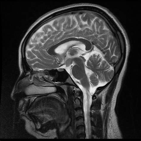 Tuber cinereum hamartoma | Radiology Case | Radiopaedia.org | Radyoloji ...