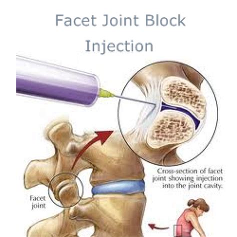 Accurate Education – Facet Joint Injections and Nerve Procedures