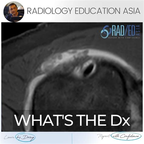 SUBACROMIAL SUBDELTOID BURSITIS MRI RADIOLOGY (VIDEO) - Radedasia