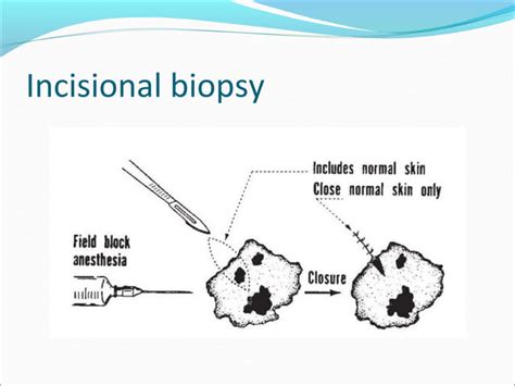 Biopsy | PPT