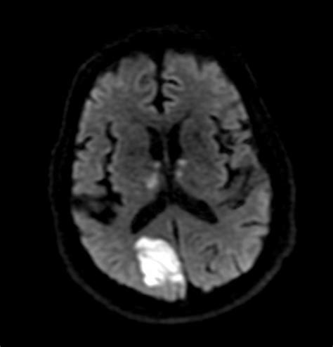 Neuroanatomy Glossary: Visual Field Defect: Macular Sparing | ditki medical & biological sciences