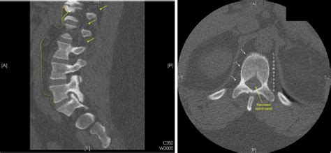 CT scan of the lumbar spine demonstrating epidural fat impinging the... | Download Scientific ...