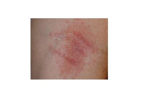 Asp Sting: Signs and Treatment - Health Advisor