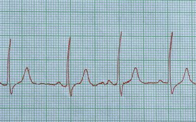 Sinus rhythm with pac ecg 671152-Sinus rhythm with pac treatment