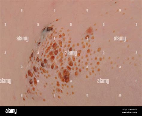 Cutaneous hi-res stock photography and images - Alamy