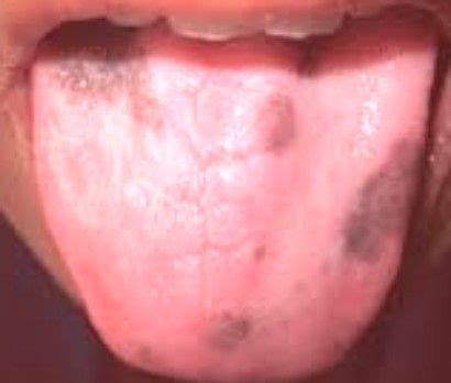 Black Spots on Tongue - Meaning, Pictures, Causes, | Black spot, Black ...