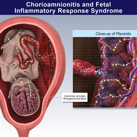 Chorioamnionitis