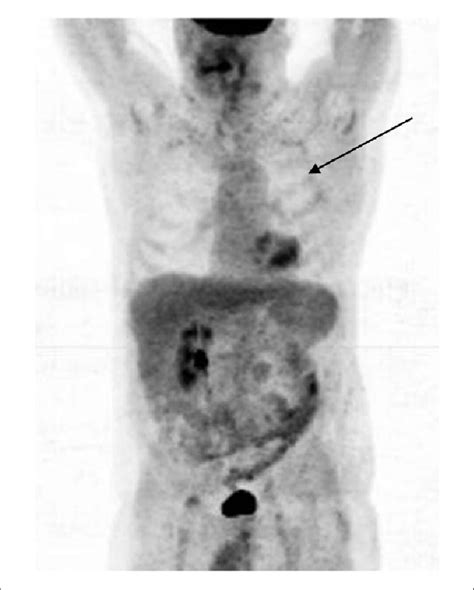 PET/CT scan, September 2013. | Download Scientific Diagram