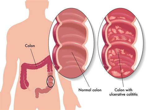 Colitis: 10 Colitis Symptoms