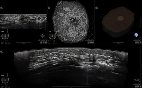 3-D Automated Breast Ultrasound (ABUS) - Διαγνωστική Μαστογραφία