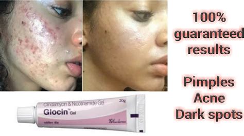 Glocin Gel Full Review Effect And Side Effect Best For Acne, 56% OFF