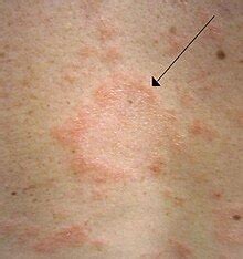 Pityriasis rosea - Wikipedia