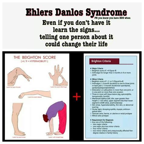 Pin by T-Jo on Health care | Ehlers danlos awareness, Ehlers danlos syndrome awareness, Ehlers ...