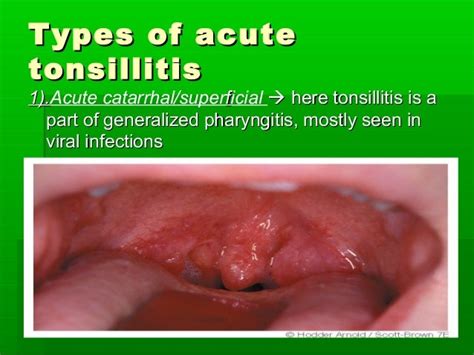 Acute & chronic tonsillitis and their management