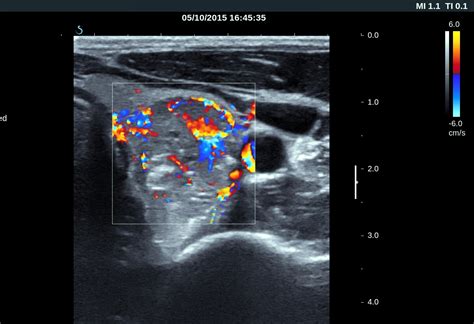 VIETNAMESE MEDIC ULTRASOUND: CASE 338: THYROID CANCER, Dr PHAN THANH ...