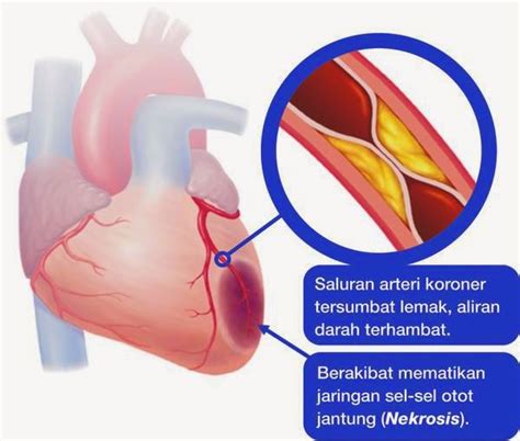 Obat Tradisional Penyempitan Pembuluh Darah Jantung - Apotikid.com