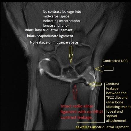 Ulnar Collateral Ligament Wrist Mri