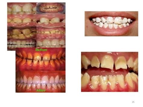 Lec 10, 11 level 4-de (biochemistry of teeth, saliva and dental carie…