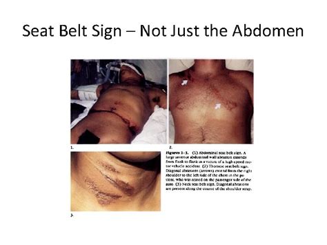 The Initial Assessment and Evaluation of Abdominal Trauma