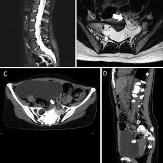 Lumbar MRI shows dural ectasia (A) and an anterior meningocele from the... | Download Scientific ...