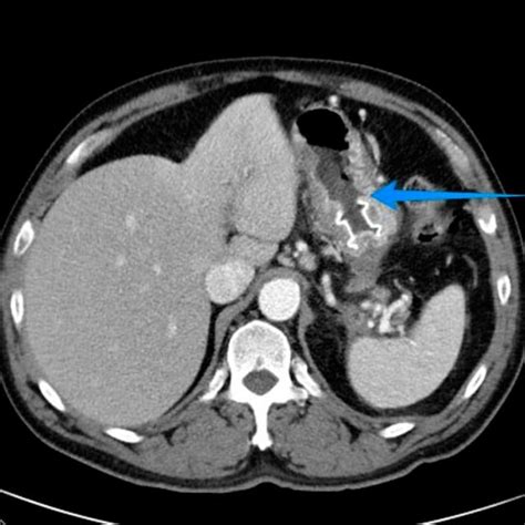 (PDF) Spontaneous Closure of a Large Transmural Gastric Defect After ...