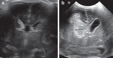 Ventricular Hemorrhage Neonatal