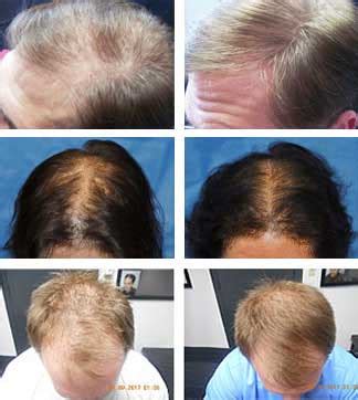 Laser Treatments for Hair Loss | Laser Hair Therapy CT