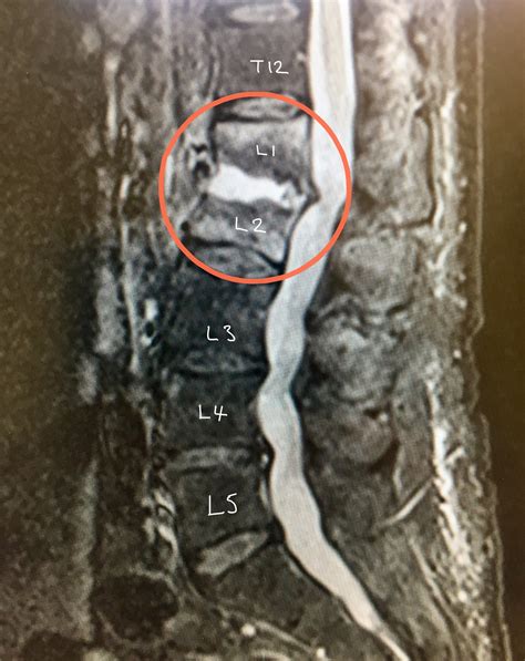 Infections In The Spine - Spines Dorset