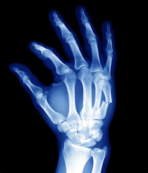 Hand Fracture | SPORT Orthopedics | Dallas & Frisco, TX