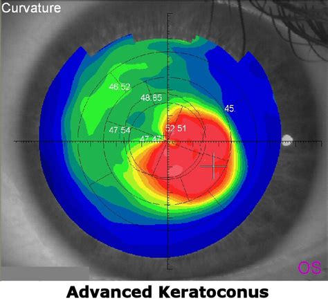 Scleral Contact Lenses for Keratoconus Treatment - The Eye Doc Blog