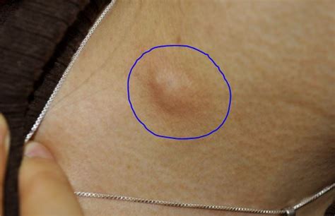 Painful Lump in Armpit Pictures, Treatment of Sore, Large or Pea Sized ...