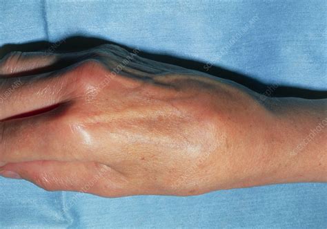 Swollen right hand due to osteoarthritis in wrist - Stock Image - M110/0332 - Science Photo Library