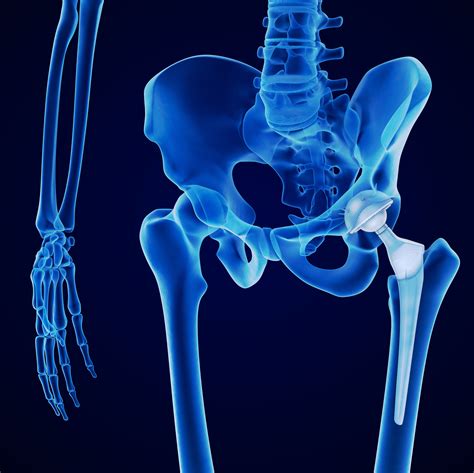 Benefits of the Anterior Approach to Hip Replacement Surgery