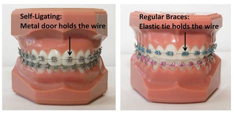 Self-Ligating Braces - West Valley City Salt Lake UT | Granger Orthodontics