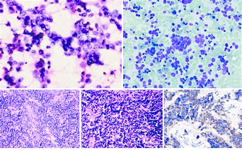 Histopathology and cytology of lymph node samples of illustrative case ...