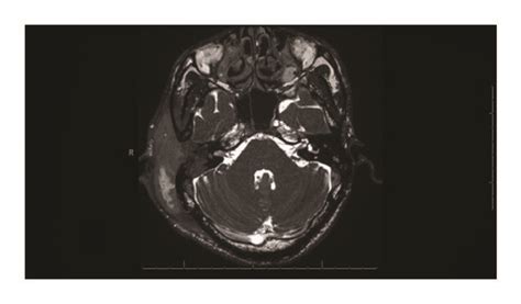 MRI of the brain, IAC, and mastoid with IV contrast. Axial and coronal... | Download Scientific ...