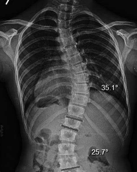 Spinal Technology | Types of Scoliosis