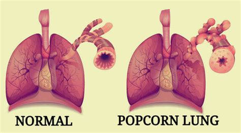 Will Vaping Give You Popcorn Lung? - Element E-Liquids