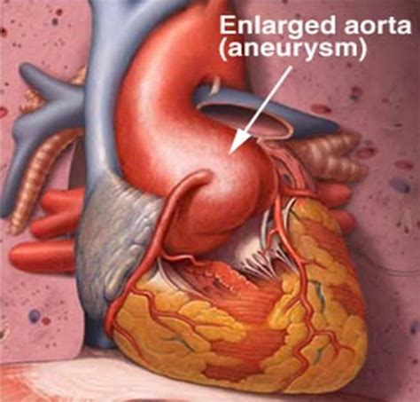 Enlarged Aorta - Symptoms, Treatment, Surgery, Pictures | hubpages