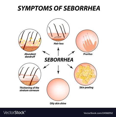 Symptoms of seborrhea seborrhea skin and hair Vector Image