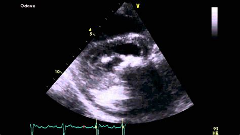 Severe Mitral Stenosis - Transthoracic Echocardiogram (TTE) - YouTube