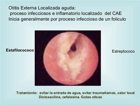 Candida Otitis Externa