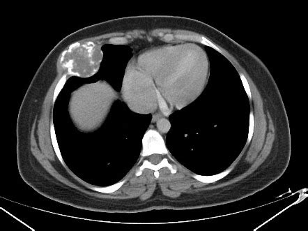 Rib chondrosarcoma | Radiology Case | Radiopaedia.org