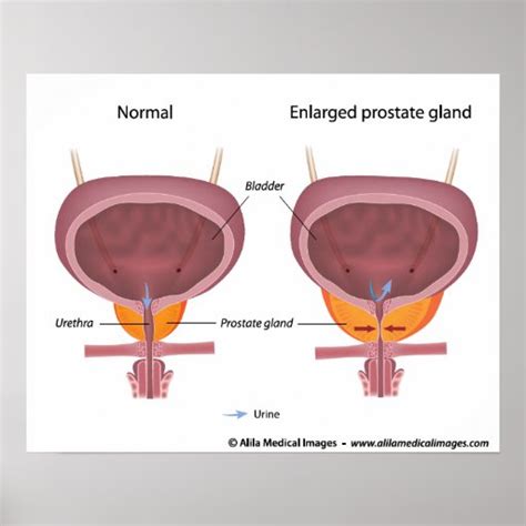 Benign prostatic hyperplasia, labeled diagram. poster | Zazzle