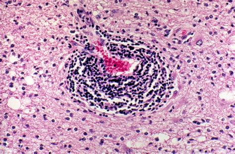 The central vein sign in MS – Multiple Sclerosis Research Blog