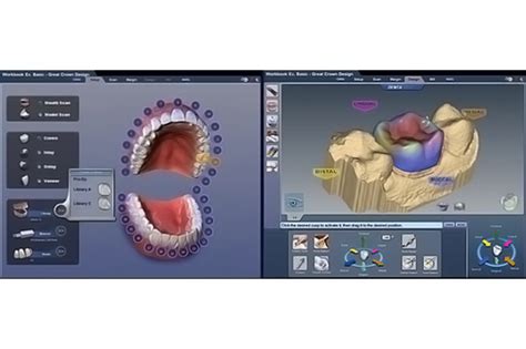 Cad Cam Technology for Crowns - Dental Home ClinicDental Home Clinic