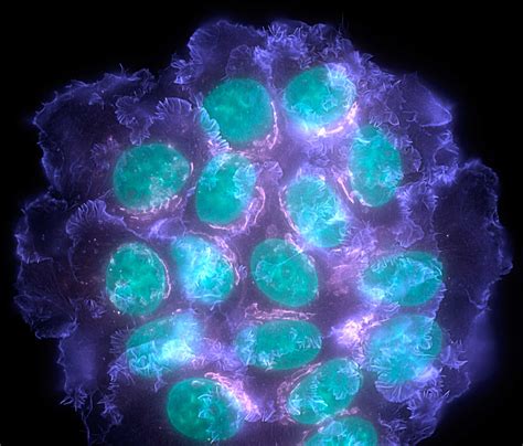 This is what breast cancer looks like under a powerful fluorescent microscope : pics