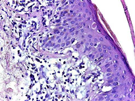 Large plaque parapsoriasis: interface dermatitis , single... | Download Scientific Diagram