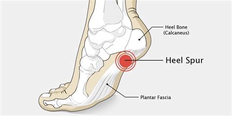 Heel Spur | Calcaneal Spur | Heel Pain Treatment | City Physiotherapy